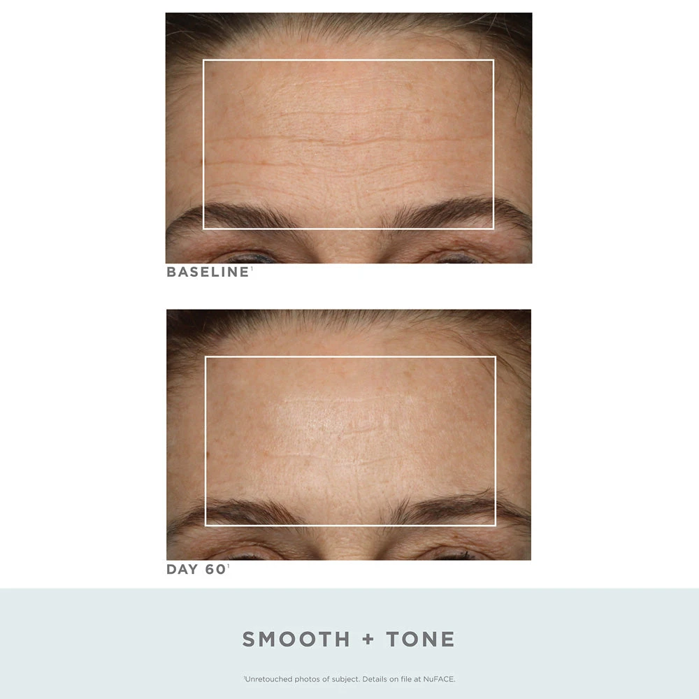 NuFACE Trinity Pro Facial Toning Kit + Wrinkle Reducer